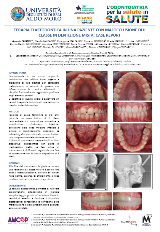 Terapia Elastodontica in una Paziente con Malocclusione di II Classe in Dentizione Mista