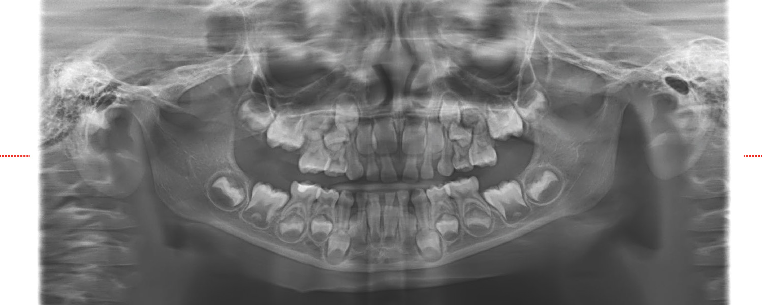 Malocclusione del tipo II Classe deep bite dentale - Eccellenze ...